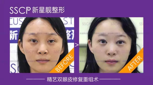 雙眼皮修復