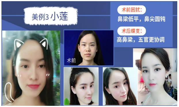 歐陽春隆鼻案例