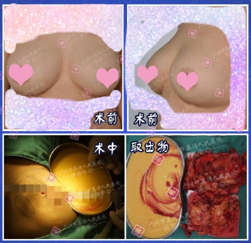 鄧正軍奧美定取出案例