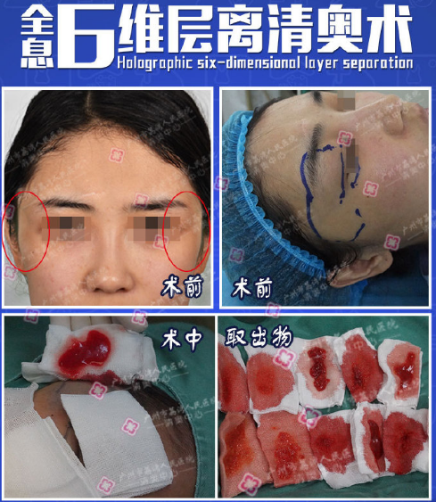 鄧正軍奧美定取出案例