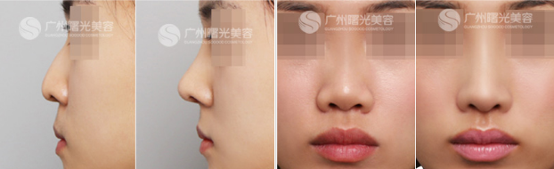 劉杰偉隆鼻案例