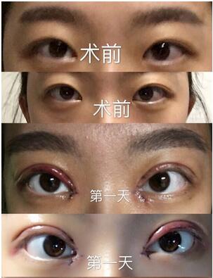 靳小雷雙眼皮修復案例