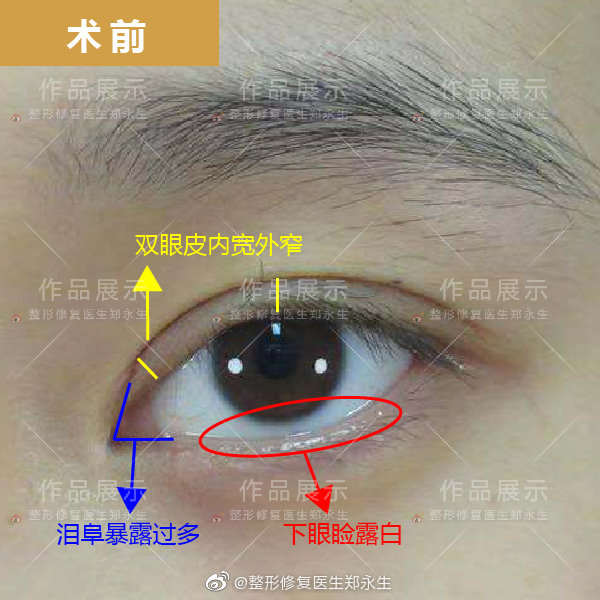 鄭永生雙眼皮修復