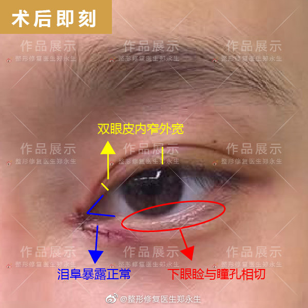 鄭永生雙眼皮修復
