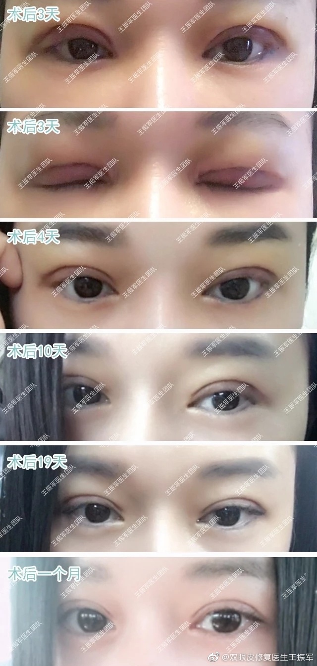 王振軍雙眼皮修復