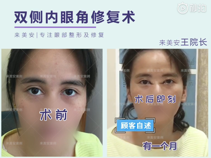 王振軍雙眼皮修復案例