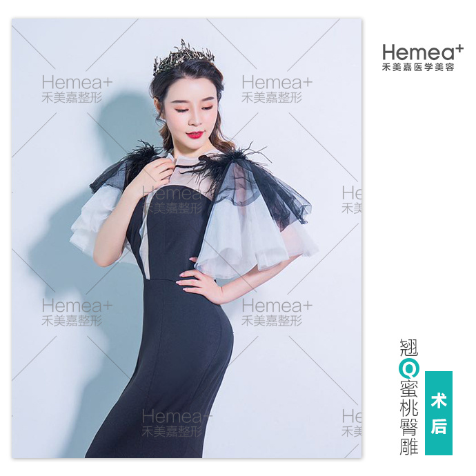 任學會豐臀案例