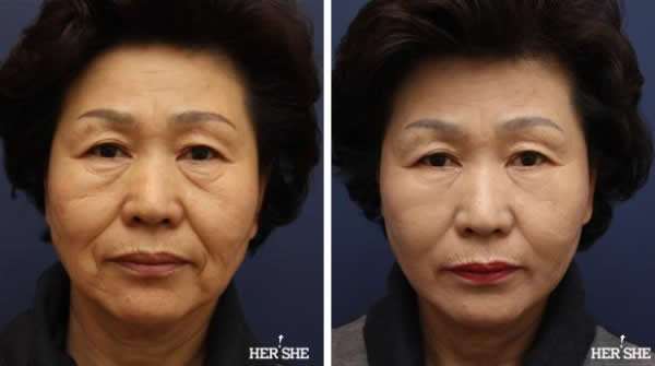 上海九院李青鋒和張余光做面部提升哪位好？