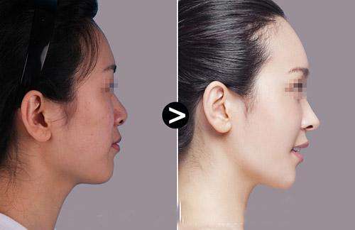 上海九院自體隆鼻價格是多少?陳付國和李圣利哪個醫(yī)生做的好?
