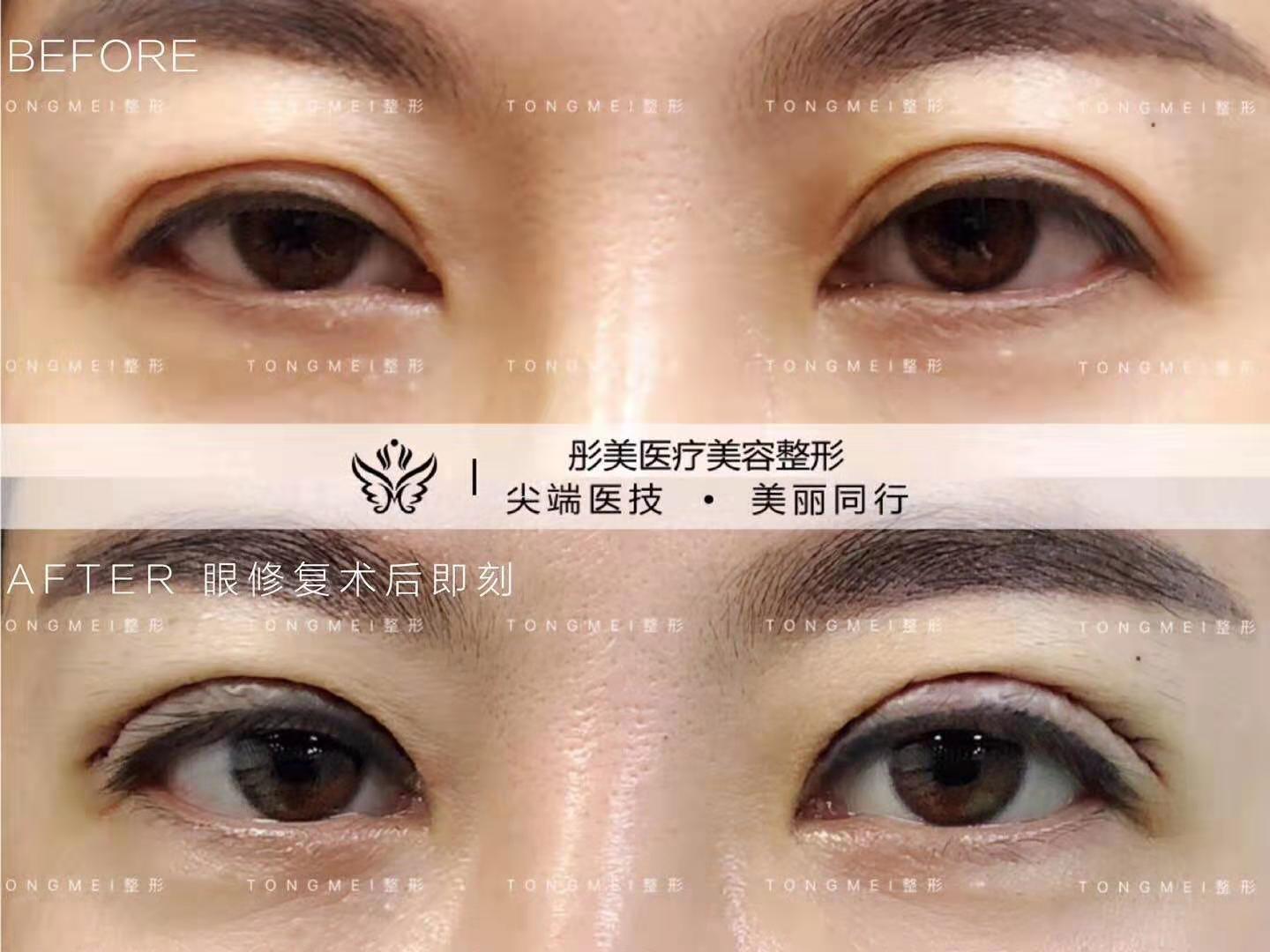 雙眼皮修復(fù)
