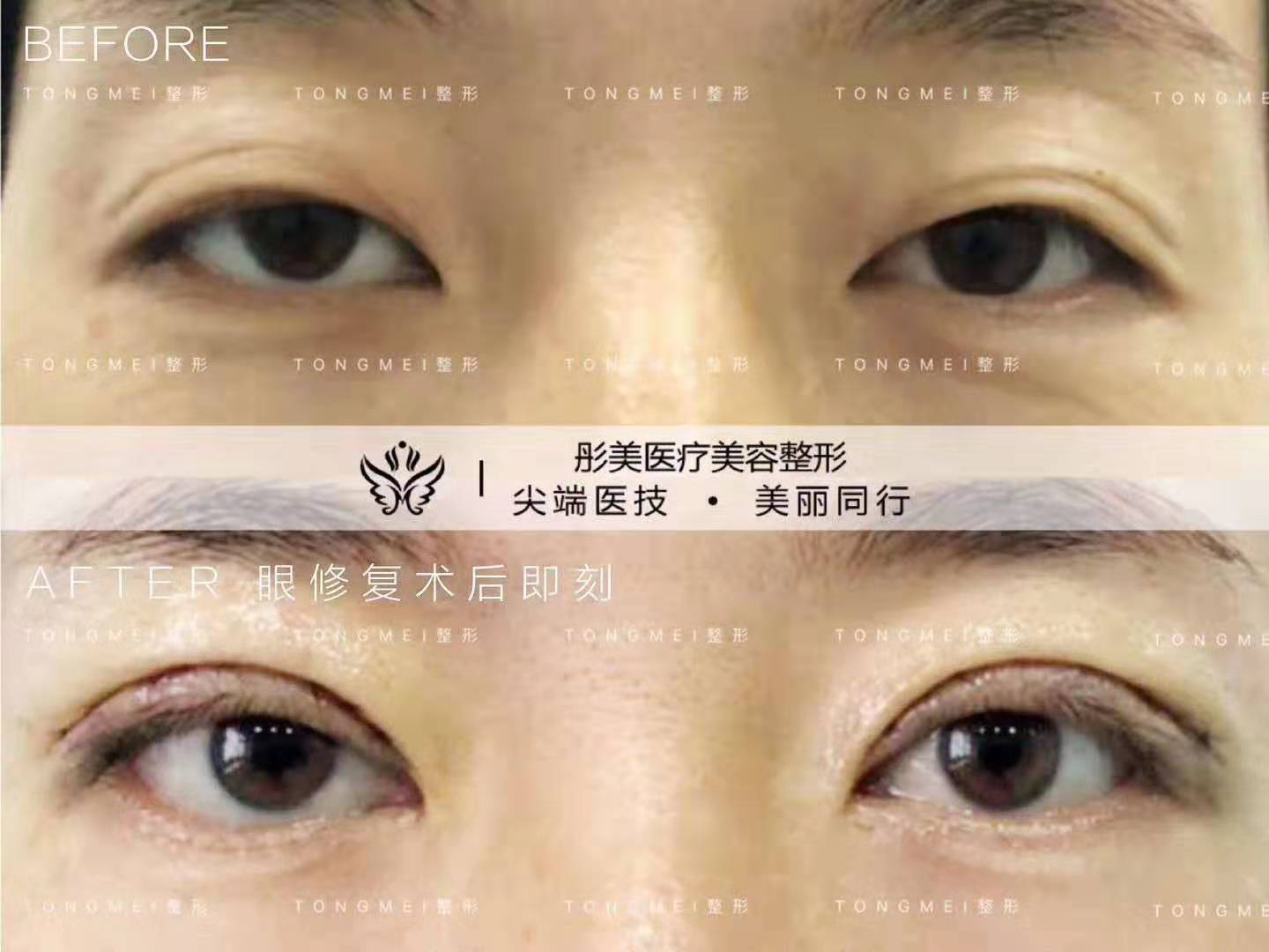 劉風(fēng)卓雙眼皮修復(fù)案例
