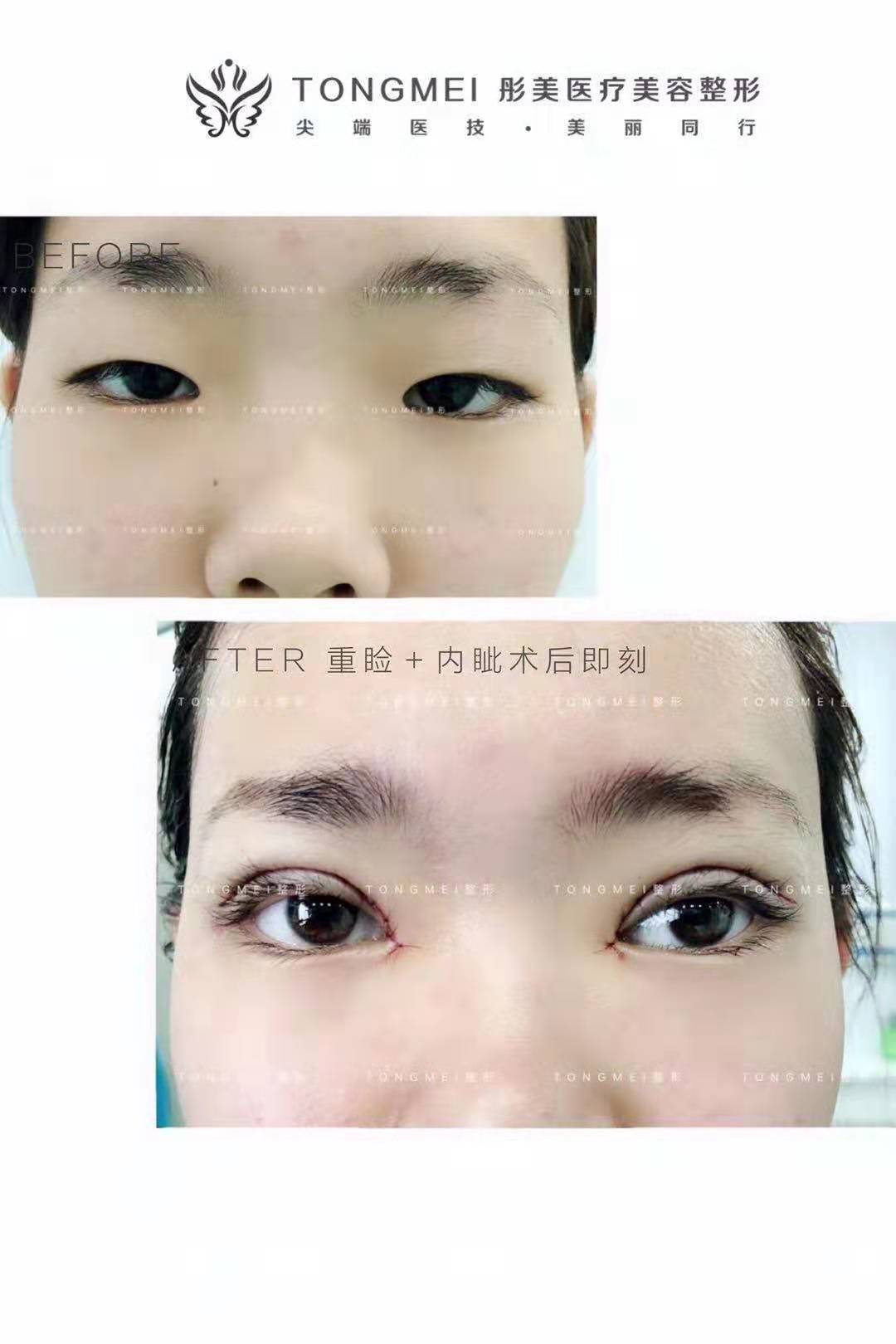 劉風(fēng)卓雙眼皮案例