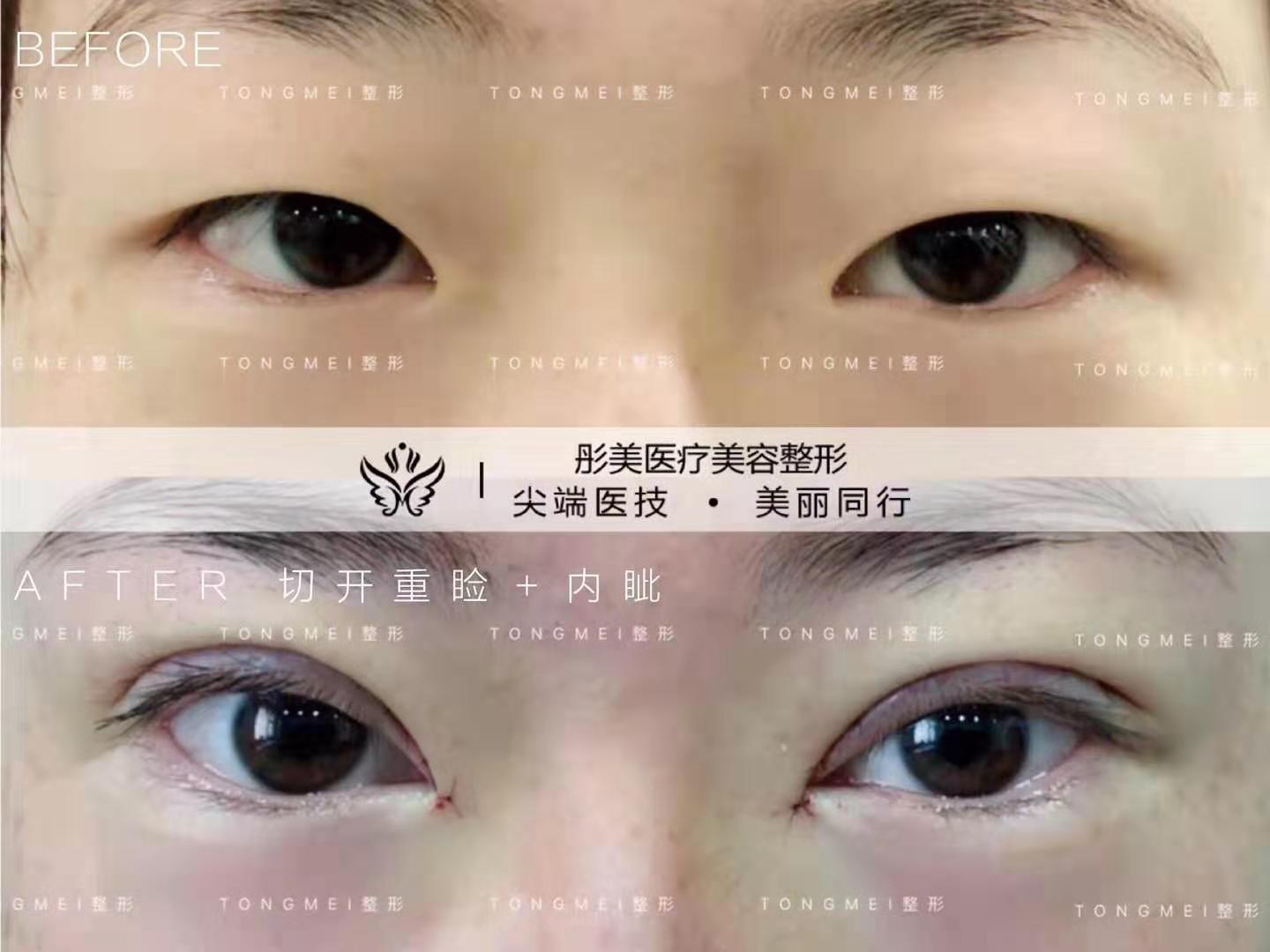 劉風(fēng)卓雙眼皮案例