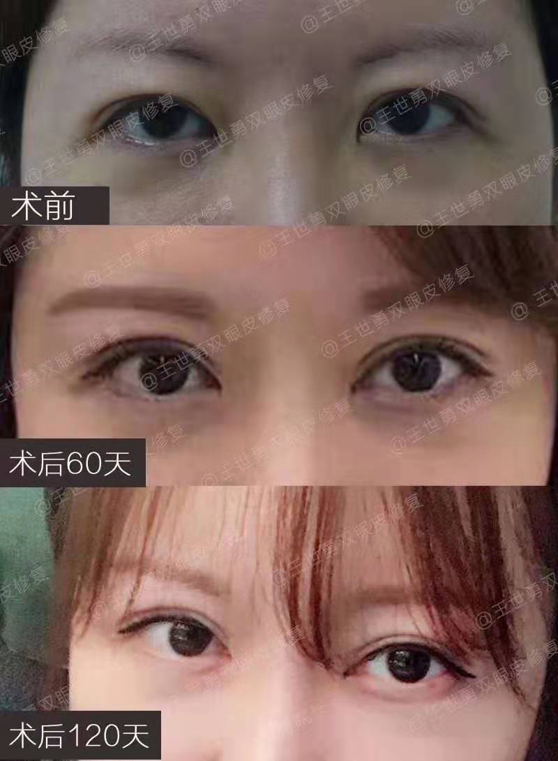 王世勇雙眼皮修復