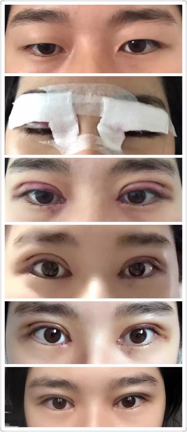 劉育鳳雙眼皮案例