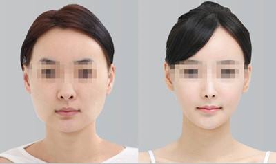 上海磨骨和下頜角哪個做的最好？李志海和何晉龍哪個好？