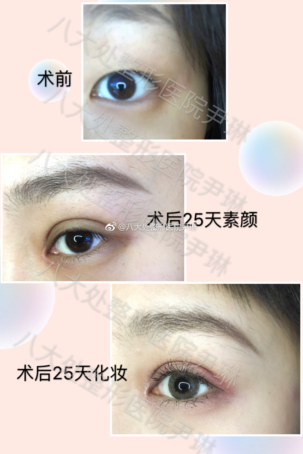 尹琳雙眼皮案例