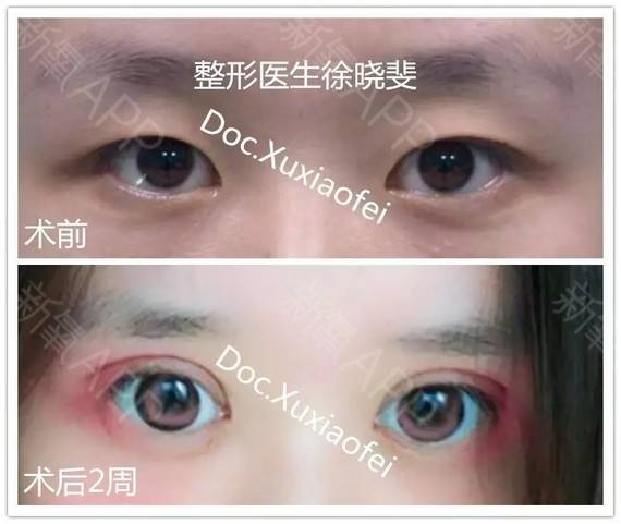 徐曉斐雙眼皮案例