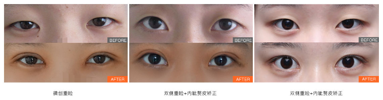 八大處宋濤雙眼皮案例