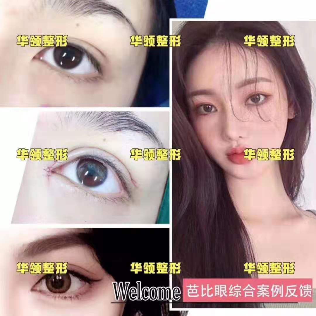 張永濤雙眼皮案例