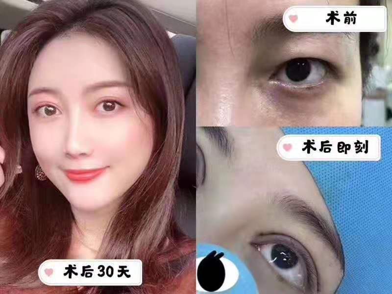 鄭州割雙眼皮哪個醫生做的好？張洪波和張永濤哪個好？