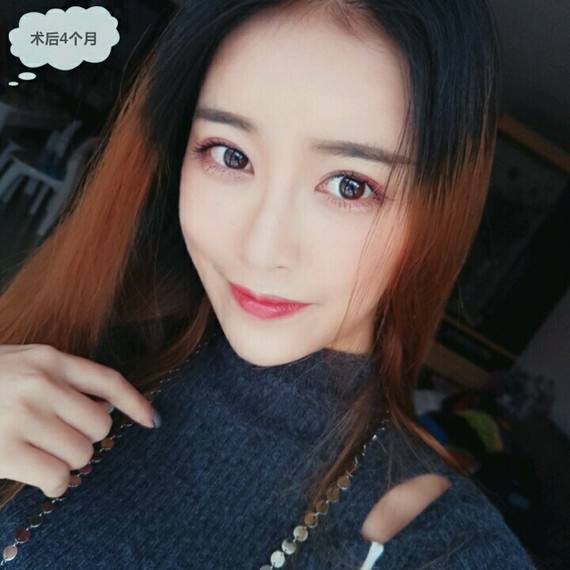 廣州割雙眼皮誰最好？黃勝華和顏玲哪個好？