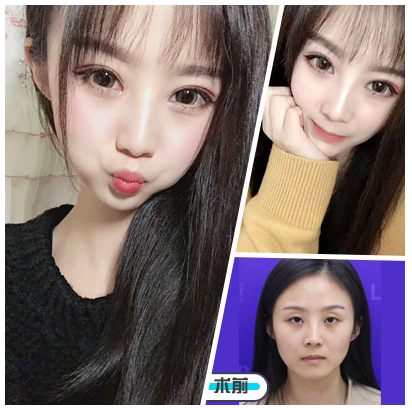 周長兵雙眼皮案例
