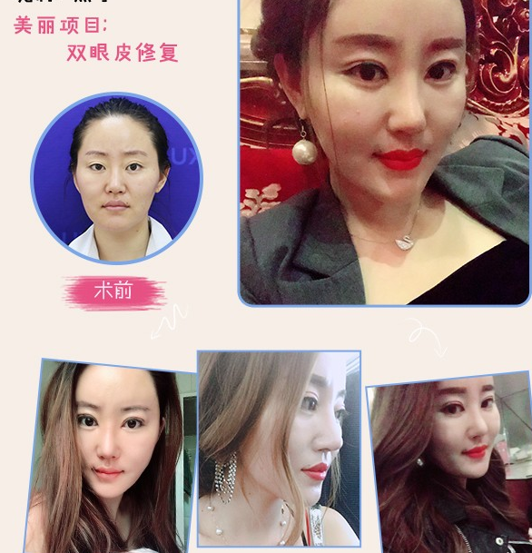 周長兵雙眼皮修復案例
