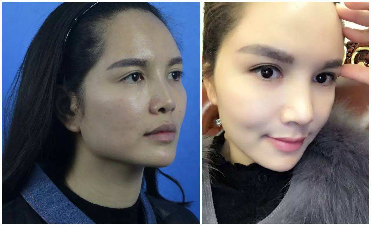 上海隆鼻哪個醫院和醫生好？大概需要多少錢？肋骨鼻好嗎？
