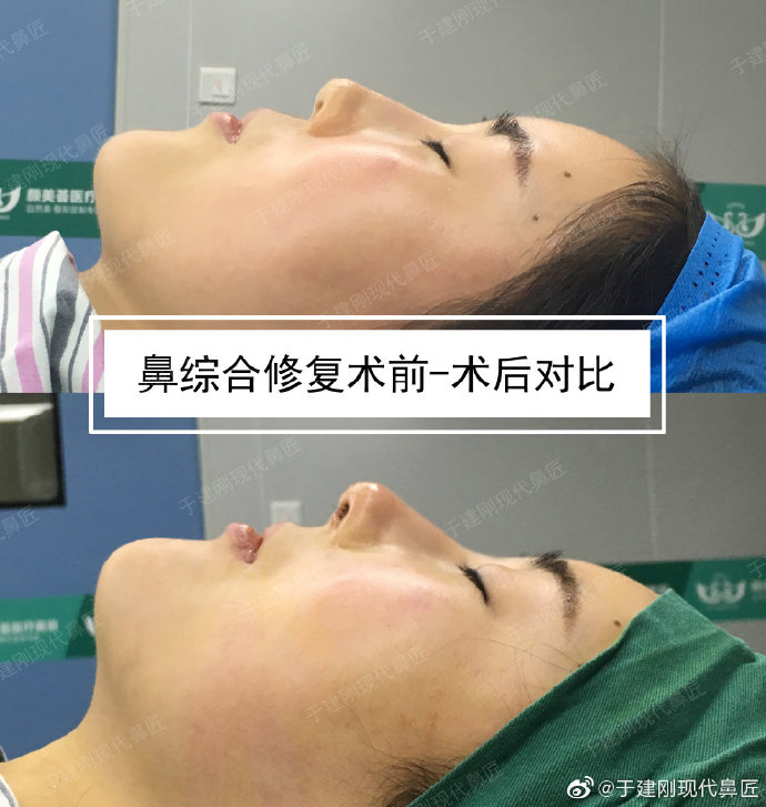 于建剛鼻修復(fù)案例