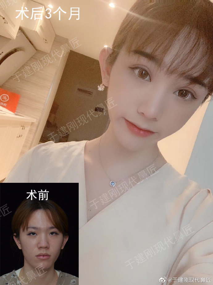 于建剛鼻修復(fù)案例