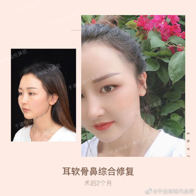 于建剛鼻修復(fù)