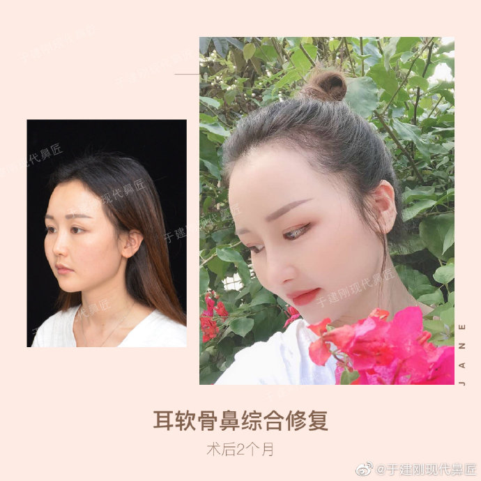 于建剛鼻修復(fù)案例