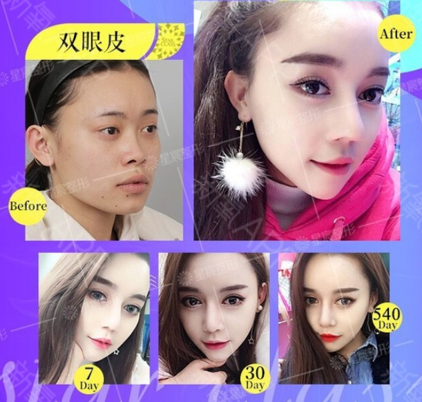 彭紹宗雙眼皮案例