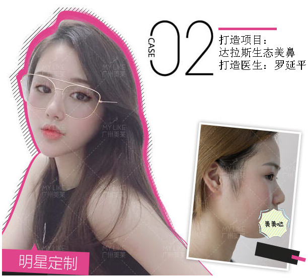 羅延平肋骨做鼻子好嗎？鼻綜合效果好不好？