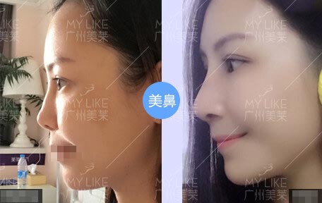羅延平美鼻案例
