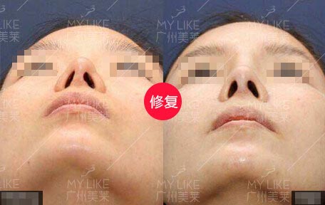 羅延平美鼻案例