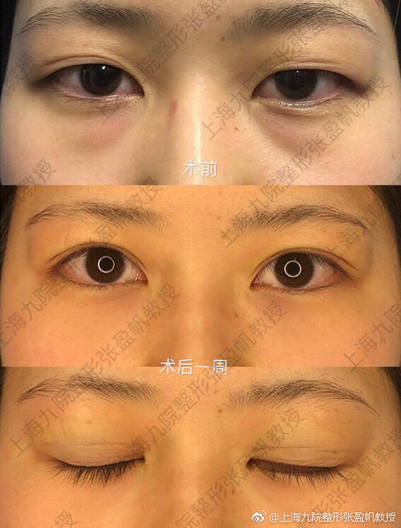 上海九院做眼綜合大概多少錢？哪個醫生最好？