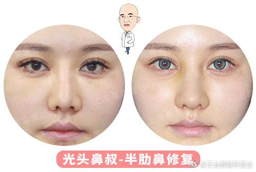 王會勇鼻修復案例
