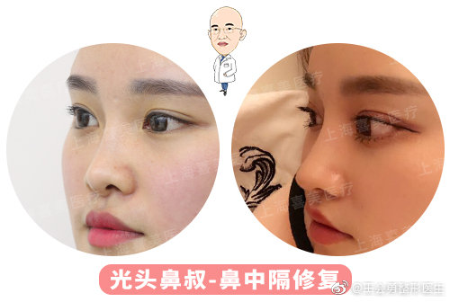 王會勇鼻修復案例