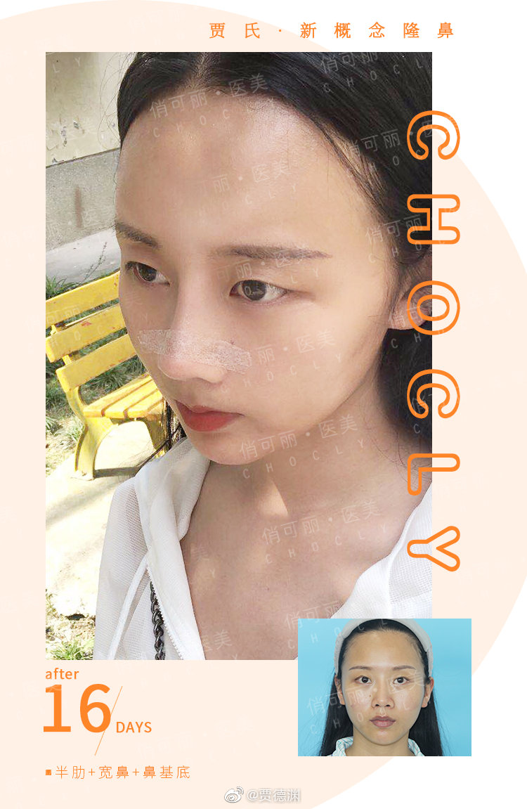賈德淵隆鼻案例