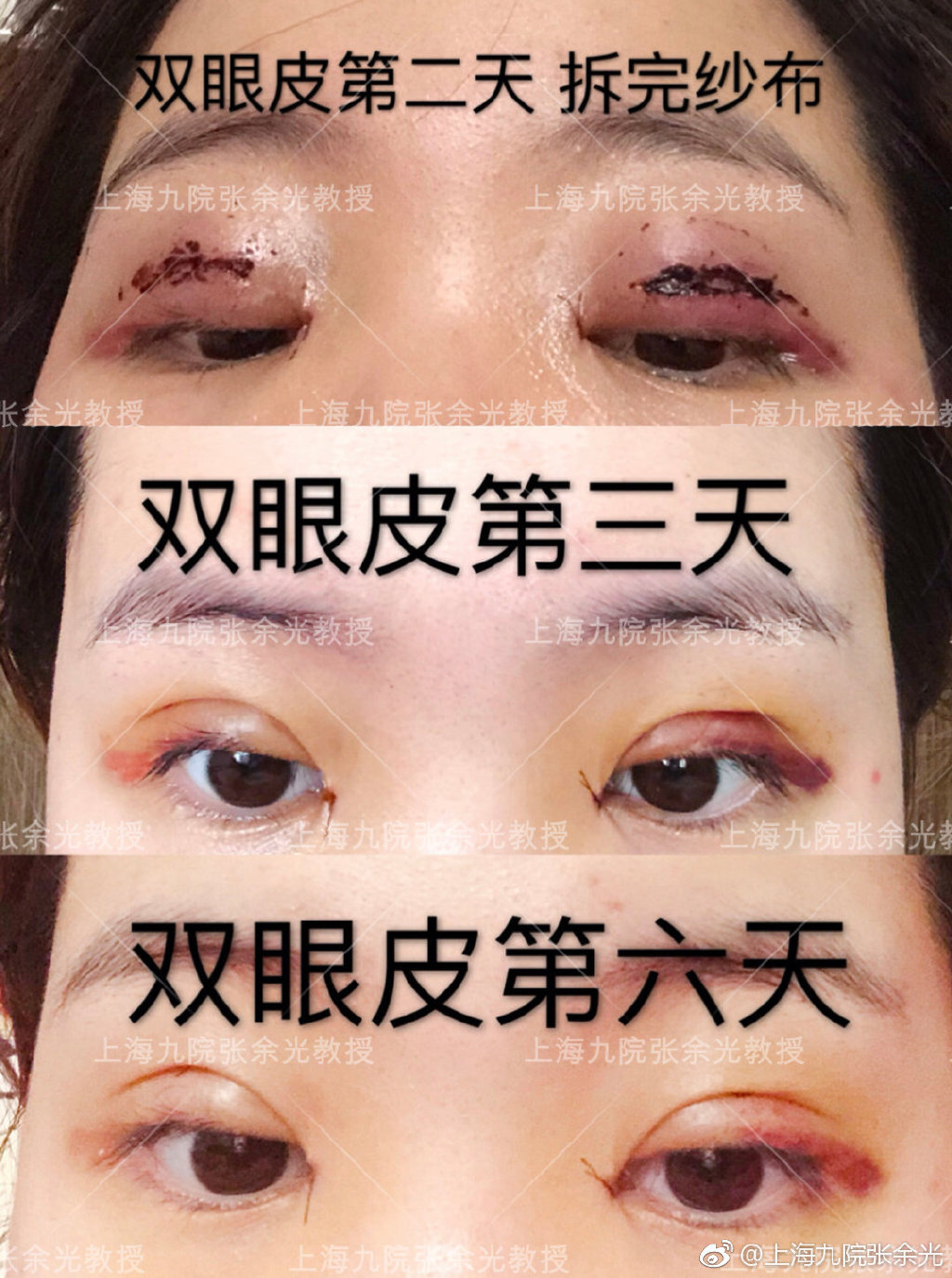 雙眼皮