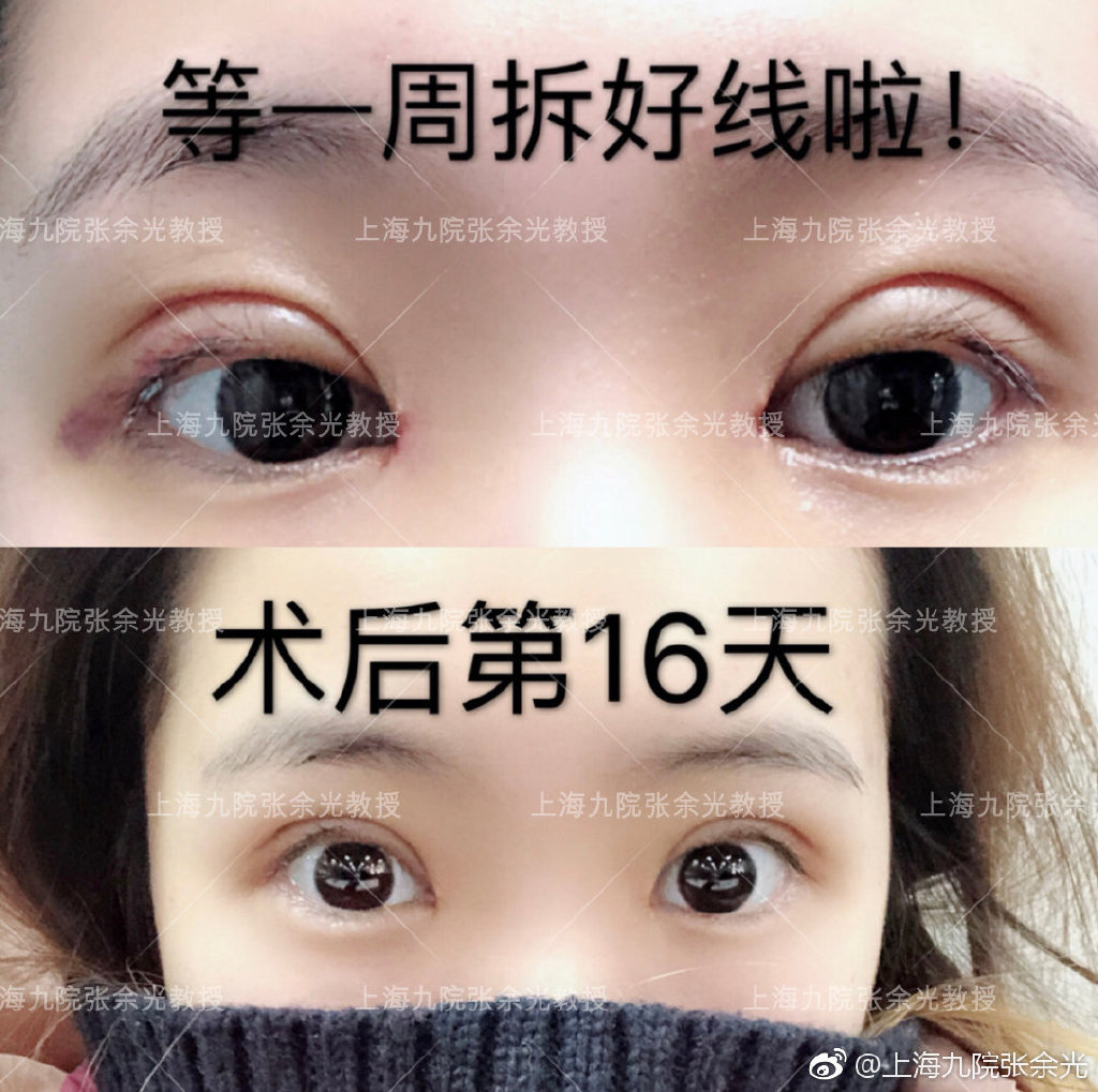 張余光雙眼皮案例
