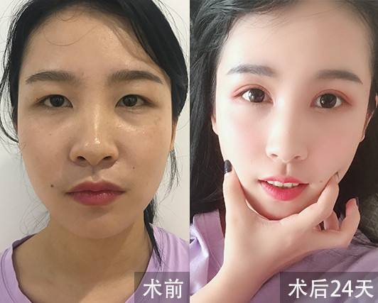 上海九院林曉曦、張余光做雙眼皮誰好？