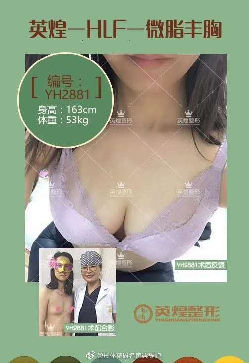 梁耀嬋自體脂肪豐胸案例