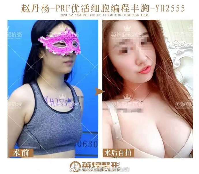 梁耀嬋自體脂肪豐胸案例