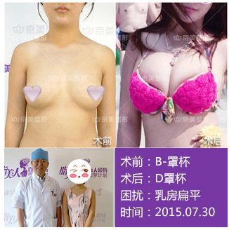 劉成勝自體脂肪豐胸案例