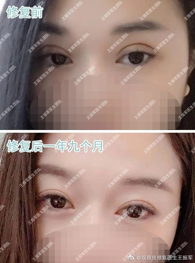 王振軍雙眼皮修復案例