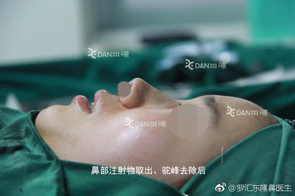 羅匯東鼻注射物取出