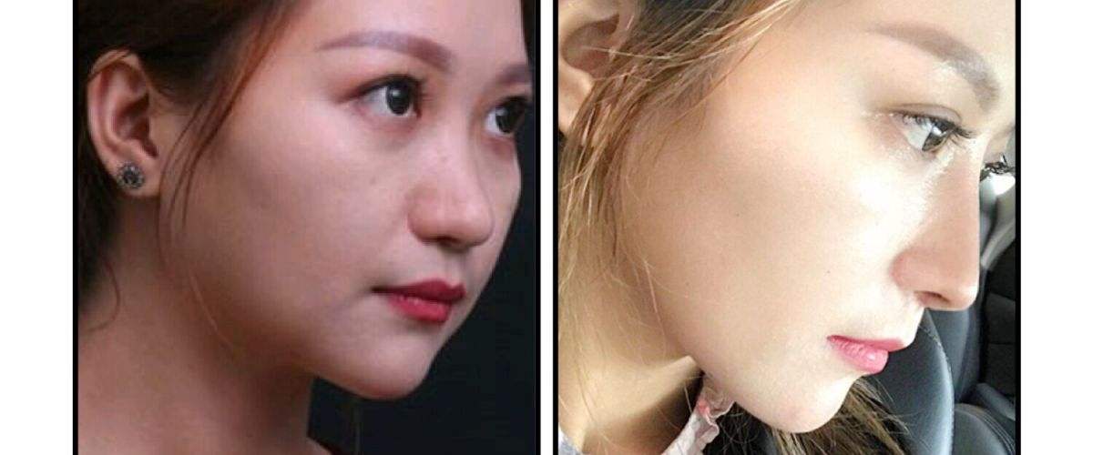 廣州羅延平和歐陽春哪個隆鼻技術好？貴不貴？